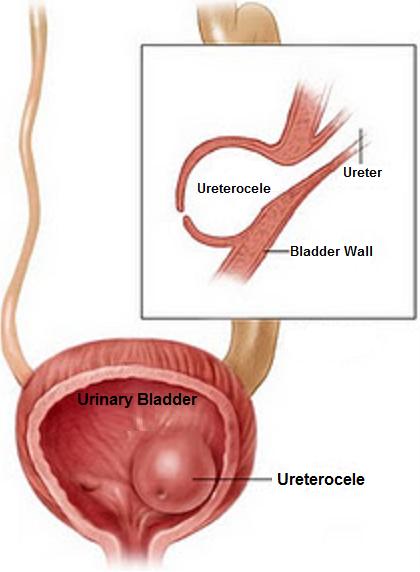 ureterocele2