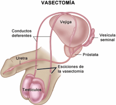 vasectomia